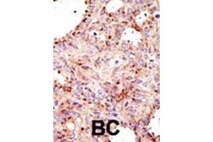 Formalin-fixed and paraffin-embedded human cancer tissue reacted with the primary antibody, which was peroxidase-conjugated to the secondary antibody, followed by AEC staining. (ARFGAP1 anticorps  (C-Term))