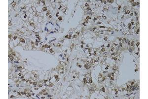 Immunohistochemistry of paraffin-embedded human gastric cancer using HUS1 antibody (ABIN6131776, ABIN6142084, ABIN6142086 and ABIN6218116) at dilution of 1:100 (40x lens).