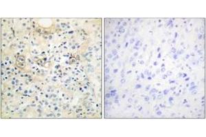 Immunohistochemistry analysis of paraffin-embedded human prostate carcinoma tissue, using TM16G Antibody. (Anoctamin 7 anticorps  (AA 881-930))