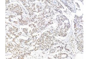 ABIN7094711 and ABIN7098762 at 1/100 staining Human breast cancer by IHC-P. (Histone H1.5 anticorps  (N-Term))