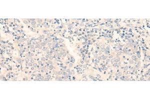 Immunohistochemistry of paraffin-embedded Human cervical cancer tissue using ADGRE3 Polyclonal Antibody at dilution of 1:35(x200) (EMR3 anticorps)