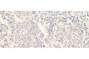 Immunohistochemistry of paraffin-embedded Human cervical cancer tissue using ADGRE3 Polyclonal Antibody at dilution of 1:35(x200)