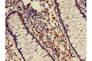 Immunohistochemistry of paraffin-embedded human colon cancer using ABIN7145576 at dilution of 1:100 (ATIC anticorps  (AA 301-592))