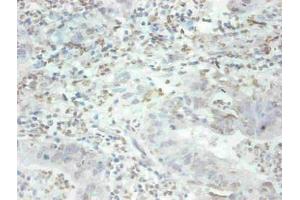 Immunohistochemical of paraffin-embedded human breast cancer tissue using ABIN7159679 at dilution of 1:200 (MFGE8 anticorps)