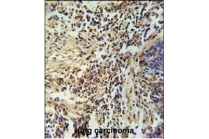 ZN Antibody (Center) (ABIN654974 and ABIN2844614) immunohistochemistry analysis in formalin fixed and paraffin embedded human lung carcinoma followed by peroxidase conjugation of the secondary antibody and DAB staining. (ZNF720 anticorps  (AA 34-62))