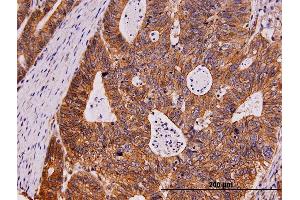 Immunoperoxidase of monoclonal antibody to KIT on formalin-fixed paraffin-embedded human stomach carcinoma. (KIT anticorps  (AA 41-140))