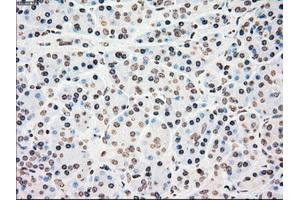 Immunohistochemical staining of paraffin-embedded colon tissue using anti-CHEK2mouse monoclonal antibody. (CHEK2 anticorps)