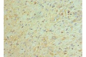 Immunohistochemistry of paraffin-embedded human glioma using ABIN7145171 at dilution of 1:100