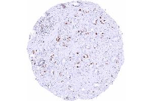 Prostatic adenocarcinoma Gleason 336 with moderate to strong MCM2 staining of a significant fraction of tumor cells