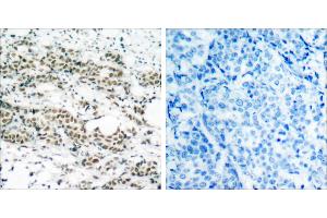 P-Peptide - +Immunohistochemical analysis of paraffin- embedded human breast carcinoma tissue using AFX (phospho-Ser197) antibody. (FOXO4 anticorps  (pSer197))