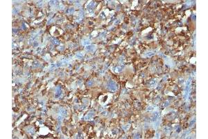 Formalin-fixed, paraffin-embedded human Histiocytoma stained with CD68 Mouse Monoclonal Antibody (C68/684). (CD68 anticorps)