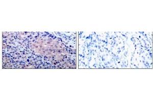 Immunohistochemical analysis of paraffin-embedded human breast carcinoma tissue using IκB-α (Ab- 32/36) antibody (E021122). (NFKBIA anticorps)