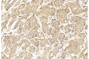 Immunohistochemical analysis of paraffin-embedded Human Breast cancer section using Pink1 (ABIN6243595 and ABIN6577086).