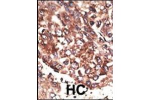 Formalin-fixed and paraffin-embedded human cancer tissue reacted with the primary antibody, which was peroxidase-conjugated to the secondary antibody, followed by AEC staining.