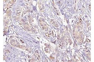 ABIN6274885 at 1/100 staining Human breast cancer tissue by IHC-P.