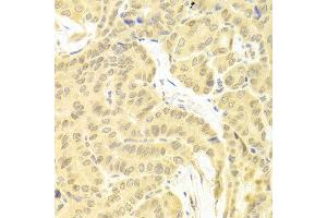 Immunohistochemistry of paraffin-embedded human thyroid cancer using CFLAR antibody at dilution of 1:100 (x400 lens). (FLIP anticorps)