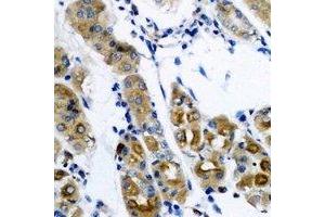 Immunohistochemical analysis of SerRS staining in human gastric cancer formalin fixed paraffin embedded tissue section. (Seryl-tRNA Synthetase (SARS) anticorps)