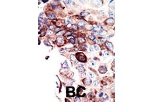 Formalin-fixed and paraffin-embedded human cancer tissue reacted with the primary antibody, which was peroxidase-conjugated to the secondary antibody, followed by DAB staining.