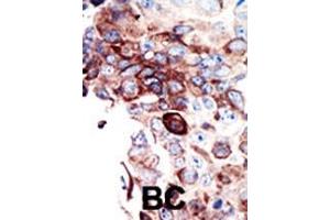 Formalin-fixed and paraffin-embedded human cancer tissue reacted with the primary antibody, which was peroxidase-conjugated to the secondary antibody, followed by DAB staining. (AXL anticorps  (C-Term))