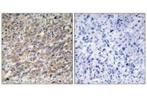 Immunohistochemistry analysis of paraffin-embedded human liver carcinoma tissue using COX17 antibody.