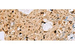 Immunohistochemistry of paraffin-embedded Human ovarian cancer tissue using MAF Polyclonal Antibody at dilution of 1:25(x200) (MAF anticorps)