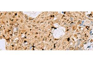 Immunohistochemistry of paraffin-embedded Human ovarian cancer tissue using MAF Polyclonal Antibody at dilution of 1:25(x200)