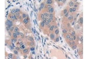 Detection of SIRT4 in Human Breast cancer Tissue using Polyclonal Antibody to Sirtuin 4 (SIRT4)