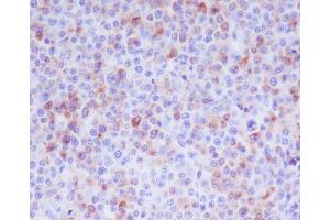 Immunohistochemical analysis of paraffin-embedded human T cell lymphoma, using Granzyme B Antibody.