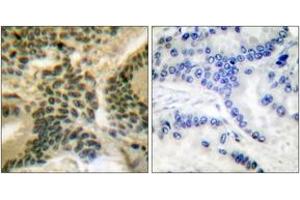 Immunohistochemistry analysis of paraffin-embedded human lung carcinoma, using PKC zeta (Phospho-Thr410) Antibody.