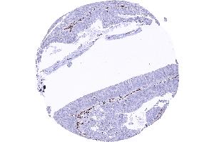 Colorectal adenocarcinoma with a complete loss of MRE11 staining in tumor cells