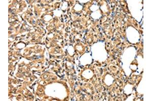 The image on the left is immunohistochemistry of paraffin-embedded Human thyroid cancer tissue using ABIN7192036(PSMB8 Antibody) at dilution 1/30, on the right is treated with synthetic peptide. (PSMB8 anticorps)