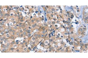 Immunohistochemistry of paraffin-embedded Human breast cancer using OTUB1 Polyclonal Antibody at dilution of 1:40 (OTUB1 anticorps)