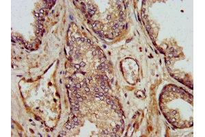 IHC image of ABIN7169503 diluted at 1:500 and staining in paraffin-embedded human prostate cancer performed on a Leica BondTM system. (SHARPIN anticorps  (AA 82-171))