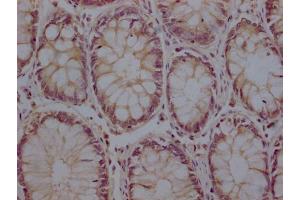 IHC image of ABIN7176722 diluted at 1:200 and staining in paraffin-embedded human colon cancer performed on a Leica BondTM system.