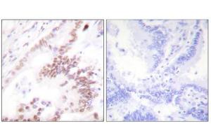 Immunohistochemistry analysis of paraffin-embedded human lung carcinoma tissue, using p300 antibody. (p300 anticorps  (N-Term))