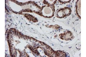 Immunohistochemical staining of paraffin-embedded Human breast tissue using anti-ATRIP mouse monoclonal antibody. (ATRIP anticorps  (AA 42-309))