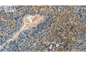 Immunohistochemistry of paraffin-embedded Human liver cancer tissue using DGK beta Polyclonal Antibody at dilution 1:60 (DGKB anticorps)