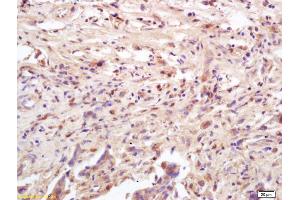 Formalin-fixed and paraffin embedded human colon carcinoma labeled with Anti-Phospho-MAPKAPK2 (Thr222) Polyclonal Antibody, Unconjugated (ABIN743678) at 1:200 followed by conjugation to the secondary antibody and DAB staining