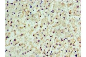 Immunohistochemistry of paraffin-embedded human liver cancer using ABIN7147368 at dilution of 1:100
