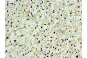 Immunohistochemistry of paraffin-embedded human liver cancer using ABIN7147368 at dilution of 1:100 (CENPQ anticorps  (AA 131-268))