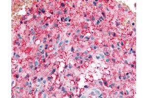 Anti-KCNMB3 antibody IHC of human Brain, Glioblastoma.