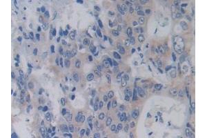 Detection of RARS in Human Colorectal cancer Tissue using Polyclonal Antibody to Arginyl tRNA Synthetase (RARS) (RARS anticorps  (AA 1-146))