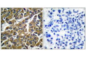 Immunohistochemical analysis of paraffin-embedded human breast carcinoma tissue, using MMP3 antibody (ABIN5976463). (MMP3 anticorps  (C-Term))