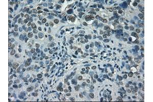 Immunohistochemical staining of paraffin-embedded Carcinoma of bladder tissue using anti-STAT1mouse monoclonal antibody. (STAT1 anticorps)