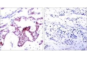 Immunohistochemistry analysis of paraffin-embedded human breast carcinoma, using NF-kappaB p65 (Phospho-Ser276) Antibody. (NF-kB p65 anticorps  (pSer276))