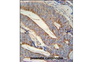 DACT1 antibody immunohistochemistry analysis in formalin fixed and paraffin embedded human prostate carcinoma followed by peroxidase conjugation of the secondary antibody and DAB staining. (DACT1 anticorps  (N-Term))