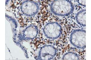 Immunohistochemical staining of paraffin-embedded Carcinoma of Human lung tissue using anti-ARHGAP25 mouse monoclonal antibody. (ARHGAP25 anticorps)