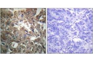 Immunohistochemistry analysis of paraffin-embedded human breast carcinoma tissue, using XPA Antibody. (PA (AA 211-260) anticorps)