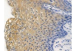 ABIN6255524 and ABIN6267296 at 1/100 staining human cervical carcinoma by IHC-P. (HSP27 anticorps  (pSer82))