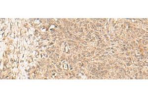 Immunohistochemistry of paraffin-embedded Human ovarian cancer tissue using FBXL4 Polyclonal Antibody at dilution of 1:25(x200) (FBXL4 anticorps)